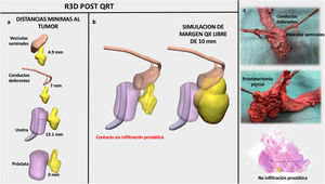 Imágenes del planificador quirúrgico 3D a partir de la RM post-neoadyuvancia. a)Distancias mínimas del tumor a diferentes estructuras calculadas mediante algoritmos matemáticos. b)Simulación de un margen quirúrgico libre de 5mm. c)Imágenes de pieza quirúrgica (amputación abdominoperineal extraelevadora +prostactectomía parcial +resección de vesículas seminales en bloque) y estudio microscópico de la relación tumoral con la próstata.