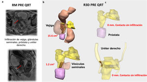 Caso real de CRLA con afectación de compartimentos pélvicos laterales y posterior. a)Corte axial y sagital de RM pre neoadyuvancia. Flecha roja: posibles zonas de infiltración tumoral. b)Imágenes del planificador 3D pre-neoadyuvancia con las posibles zonas de infiltración y su volumen. Estructura en amarillo: tumor; estructura en rojo: posibles zonas de infiltración.
