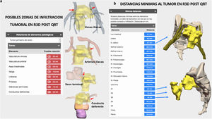 Imágenes del planificador quirúrgico 3D a partir de la RM post-neoadyuvancia. Estructura en amarillo: tumor; estructura en rojo: posibles zonas de infiltración. a)Posibles zonas de infiltración tumoral. b)Distancias mínimas del tumor a todas las estructuras.