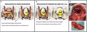 Simulación mediante el planificador 3D de: a)la visión quirúrgica y la mejor ruta anatomoquirúrgica para abordar los compartimentos laterales, y b)la simulación de margen quirúrgico libre de 5mm. Estructura en amarillo: tumor; estructura en rojo: posibles zonas de infiltración. c)Imagen real del campo operatorio y pieza quirúrgica tras la intervención exenteración pélvica total con reconstrucción urinaria tipo Bricker +incorporación en bloque de arterias iliacas internas bilateral, vena iliaca interna izquierda y común derecha, asa de íleon terminal.