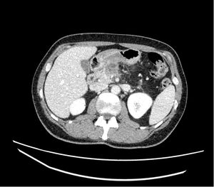 Estudio TC preoperatorio, imagen axial. Se evidencia oclusión de la vena mesentérica superior y abutment de la arteria mesentérica superior.