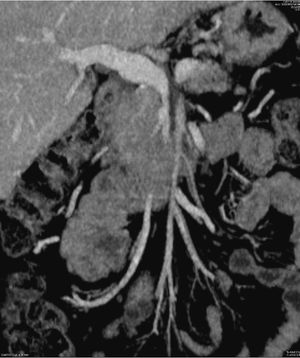 Estudio TC preoperatorio, imagen sagital. Se evidencia oclusión de la vena mesentérica superior y abutment de la arteria mesentérica superior.