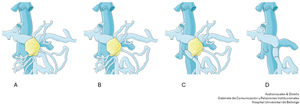 Diagrama de la afectación venosa por el tumor (A) y planificación de la reconstrucción practicada: anastomosis vena yeyunal a vena ileal2 (B), shunt íleo-cava (C), y visión final con injerto de cadáver interpuesto y suturas íleo-injerto e injerto-porta (D). Elaboración: Audiovisuales y Diseño, Gabinete de Comunicación y Relaciones Institucionales. Hospital Universitari de Bellvitge.