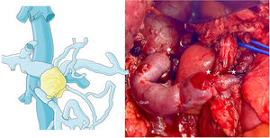 Diagrama del shunt intraoperatorio íleo-cava y fotografía intraoperatoria shunt íleo-cava. SMA: arteria mesentérica superior; CHA: arteria hepática común; PHA: arteria hepática propia; GDA: arteria gastroduodenal; SA: arteria esplénica; PV: vena porta; SV: vena esplénica; VIL: vena ileal; VIL1: vena ileal 1; VIL2: vena ileal2; VYY: vena yeyunal; IMV: vena mesentérica inferior; MSC: mesocolon. En asteriscos se señalan las suturas venosas, de vena yeyunal a vena ileal2; de vena ileal a injerto venoso; y de injerto venoso a la vena cava.