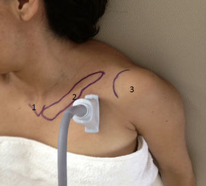 Posición del brazo en aducción. 1: horquilla esternal; 2: clavícula cercana al transductor; 3: cabeza humeral.