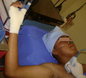 Vista lateral del paciente en decúbito dorsal para el escaneo ultrasonográfico de la región infraclavicular con el brazo en abducción.
