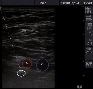 Sonoanatomía del abordaje infraclavicular. Línea punteada corresponde al trayecto del catéter. A: arteria axilar; CP: cordón posterior; PM: músculos pectorales mayor y menor; V: vena axilar.