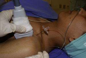 Alineación de la aguja de Tuhoy in plane en el polo superior del transductor a 5cm de profundidad y angulación a 45° respecto al transductor permitiendo la introducción del catéter.