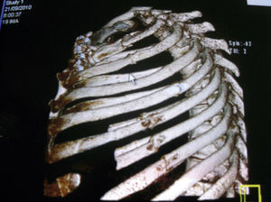 Tomografía. Se aprecian la fijación costal y la luxación esternocostoclavicular bilateral.