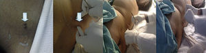 La figura muestra, de izquierda a derecha: la presencia de la fístula y la salida de líquido cefalorraquídeo a la presión del sitio de punción; así mismo, el cierre exitoso de la fístula.