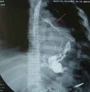 Reingreso: se observa trayecto fistuloso (flecha).