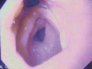 Endoscopia superior. Orifico fistuloso (flecha).