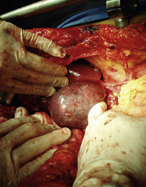 Movilización hepática en su aspecto inferior con exposición de vena cava inferior.