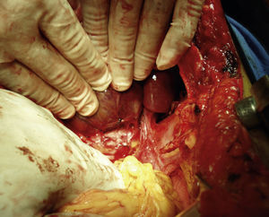 Retracción medial del tumor que expone las venas hepáticas.