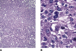 A) Aspecto microscópico de la lesión con reporte histopatológico de hepatocarcinoma celular (hematoxilina y eosina). B) La lesión tiene un patrón sólido con células neoplásicas grandes, con núcleos pleomórficos multinucleación y mitosis tetrapolares.