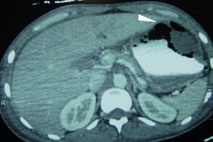 Neumatosis gástrica en el fondo y el cuerpo, edema perigástrico, en relación con gastritis enfisematosa.