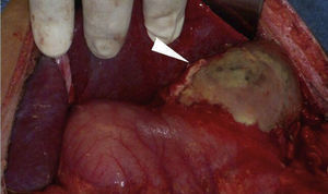 Necrosis gástrica que abarca el fondo, el cuerpo y la curvatura mayor, con úlcera gástrica posterior que involucra el cuerpo y el fondo gástrico.