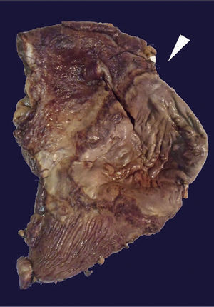 Úlcera gástrica anterior de 10 × 9cm a nivel de la curvatura mayor; úlcera posterior de 16 × 7cm café-verdosa; resto de la cámara gástrica, pared engrosada aproximadamente 1cm de espesor.