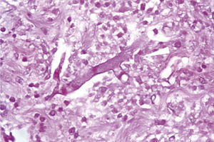 Hifas ramificadas no septadas en ángulo recto, secundarias a infección micótica por mucormicosis.