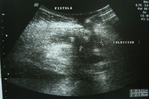 Ultrasonido de pared abdominal.