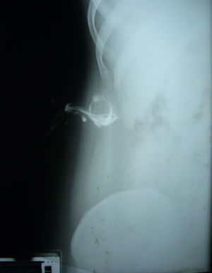 Fistulograma.