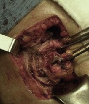 Resección de trayecto fistuloso en la pared abdominal.