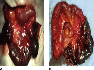 A) Laparotomía exploradora en la que se encontró una hernia interna que incluyó yeyuno isquémico. B) Resección de 60cm de yeyuno isquémico.