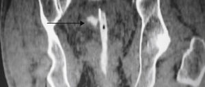 Tomografía computada abdominopélvica que muestra paso del contraste administrado hacia el tubo de drenaje perineal indicativo de perforación.