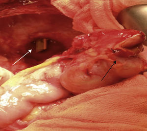Imagen operatoria que muestra tubo de drenaje introducido en la cavidad peritoneal y perforación del ciego secundaria.