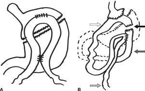 A) Bypass gástrico en omega descrito en 1996. B) Bypass gástrico simplificado en Y de Roux descrito en 2003. La fl blanca indica el asa alimentaria; la fl gris indica el asa biliar; la fl cha punteada indica el asa común; la fl cha negra indica el punto de sección entre ambas asas al final de la cirugía. Adaptado de: Lönroth et al.5.