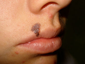 Lesión pigmentada que clínicamente hace dudar si se trata o no de un melanoma; correspondió a un melanoma in situ.