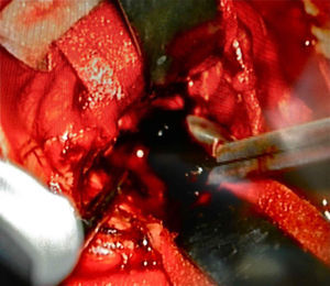 Tumor de color «negro», a través de un acceso transcortical, altamente vascularizado, intraaxial.