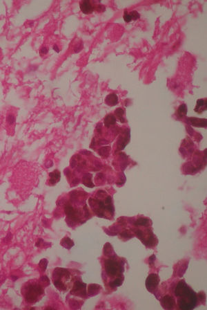 Nidos de células epitelioides, con melanina citoplasmática, núcleos pleomórficos y prominentes nucléolos, con figuras mitóticas atípicas.