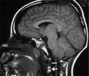 Imagen de resonancia magnética ponderada en T1 en vista sagital en donde se observa un trazo de fractura a través del clivus (flecha blanca) sin migración ósea, presencia de sangrado del diploe (línea blanca punteada) y edema cerebral. También se observa dislocación occipitocervical y atlantoaxial.