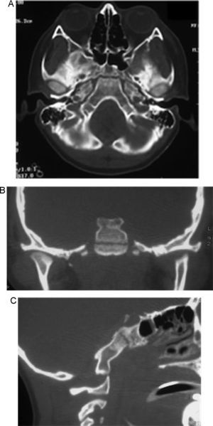 A) Imagen preoperatoria con la fractura del clivus. B) Reconstrucción preoperatoria con vista coronal de la fractura del clivus. C) Reconstrucción preoperatoria con vista sagital donde se observa dislocación occipitocervical y atlantoaxial, y fractura del clivus.