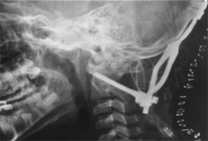Radiografía simple en proyección lateral que muestra el sistema fijación craneocervical con sistema de alambres en C1 y C2 más injerto óseo tricortical.
