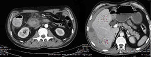 Tomografía computada abdominopélvica: hematoma duodenal y hemoperitoneo.