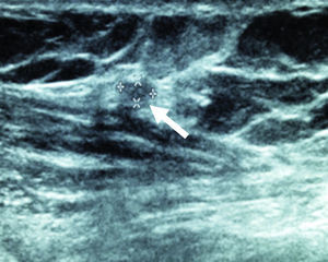 Ultrasonografía de antebrazo a 24 meses donde se aprecia el injerto (flecha).