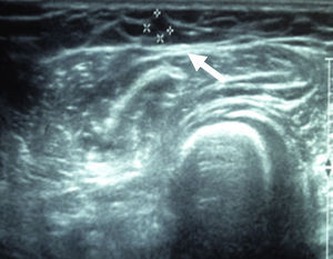 Ultrasonografía tiroidea a 24 meses donde se muestra el injerto (flecha).