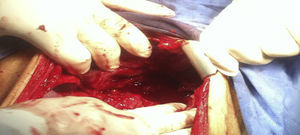 Imagen donde se encontraba plastrón de hígado, colon y epiplón ya disecado mostrando la ausencia de la pared anterior de estómago.