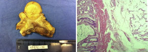 Izquierda: aspecto macroscópico del lipoma, parte superior de la pieza, se observa el lipoma. Derecha: corte histológico en el que se aprecia la capa muscular del estómago y tejido graso correspondiente a lipoma gástrico.