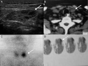 Caso 3. A) Ultrasonido de cuello donde se observa tumor de paratiroides inferior izquierda de 3.4×1.6×2.4 cm, heterogénea, áreas hiperecogénicas con degeneración quística (flecha). B) Tomografía de cuello con tumoración dependiente de paratiroides inferior izquierda (flecha). C) y D) SPECT CT que demuestra zona de hipercaptación en paratiroides inferior izquierda (flecha).