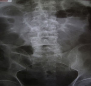 Radiografía simple de abdomen que muestra distensión intestinal sin niveles hidroaéreos y aire distal en el recto.