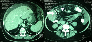 Tomografía de abdomen en la cual se observa ascitis (flecha delgada), así como un tumor en el flanco derecho comprimiendo el colon derecho (flecha gruesa), datos indicativos de carcinomatosis (cabeza de flecha).