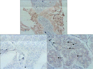 Inmunohistoquímica. Se muestra el uso de esta técnica en el tumor de ovario (imagen superior), así como en la parte de adenocarcinoma de la metástasis (inferior derecha) con receptores negativos. Y los receptores positivos a estrógenos en la parte sarcomatoide de la metástasis.