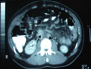 Tomografía computada de abdomen. Evidencia de múltiples lesiones nodulares (adenopatía) en retroperitoneo, ganglios paraaórticos y abdominales (flechas).
