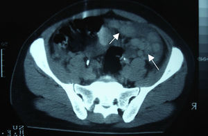 Tomografía computada de pelvis. Múltiples nódulos de forma y tamaño variable (flechas).