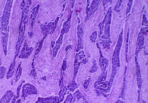 Microfotografía, ×4. Tumor constituido por células neoplásicas que se disponen en cordones y nidos, separados por tejido fibroconectivo de aspecto desmoplásico.