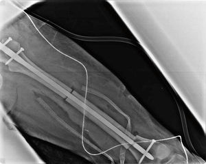 Radiografía anteroposterior de fémur. Datos en relación con osteotomías con osteosíntesis en fémur izquierdo con clavo centro medular y 3 tornillos antirrotación.