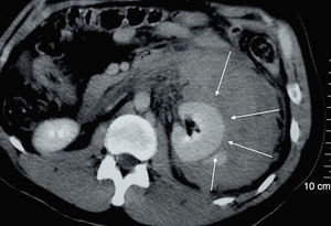 Tomografía computada que muestra hemorragia retroperitoneal secundaria a lesión metastásica de hepatocarcinoma en riñón izquierdo (las flechas blancas indican la magnitud de la hemorragia perirrenal).